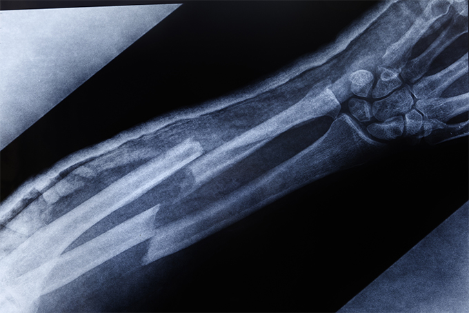X-Ray of a broken arm